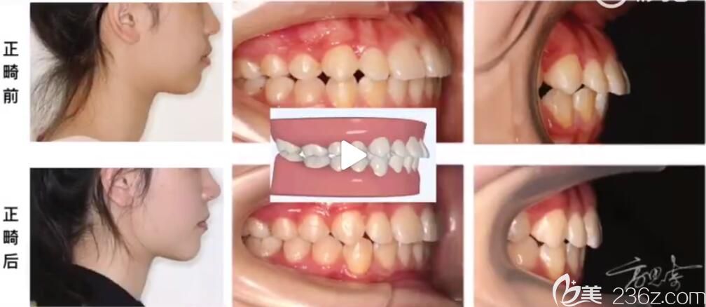 杭州美奧口腔高思奇怎么樣？牙齒矯正真人案例證明