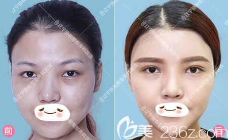 楊威雙眼皮真人前后對(duì)比