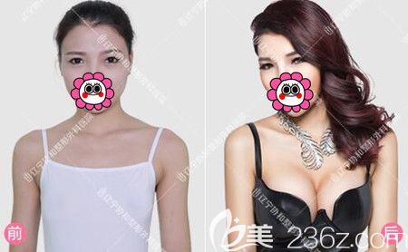 崔東胸部整形真人前后對(duì)比