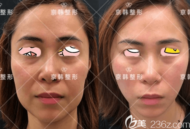 北京京韓郭尚琴醫(yī)生面部埋線提升案例 北京京韓郭尚琴醫(yī)生面部埋線提升案例