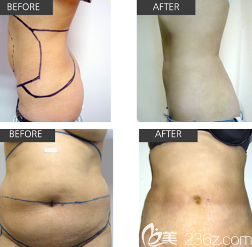 韓國CDU清潭優(yōu)吸脂手術(shù)案例