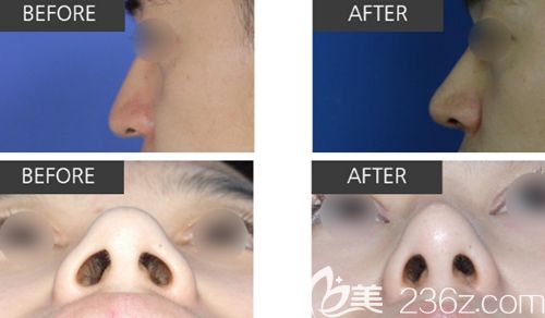 韓國清潭優(yōu)整形外科softxil鼻整形案例