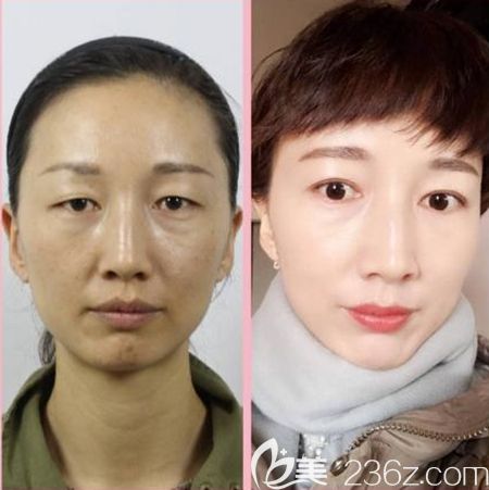 韓國清潭優(yōu)注射美膚案例