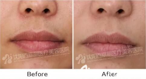 沈陽(yáng)百嘉麗冰點(diǎn)脫唇毛真人前后效果對(duì)比