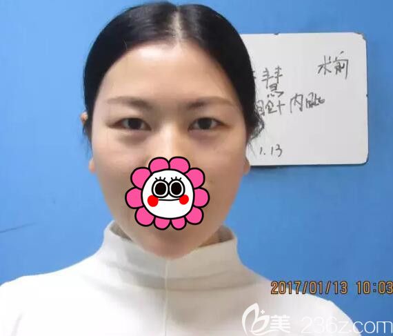 面診黎曄醫(yī)生術(shù)前單眼皮腫眼泡 面診黎曄醫(yī)生術(shù)前單眼皮腫眼泡