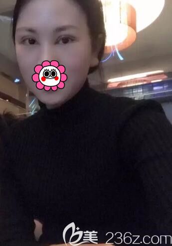 找黎曄主任做完雙眼皮5天拆線恢復(fù) 找黎曄主任做完雙眼皮5天拆線恢復(fù)