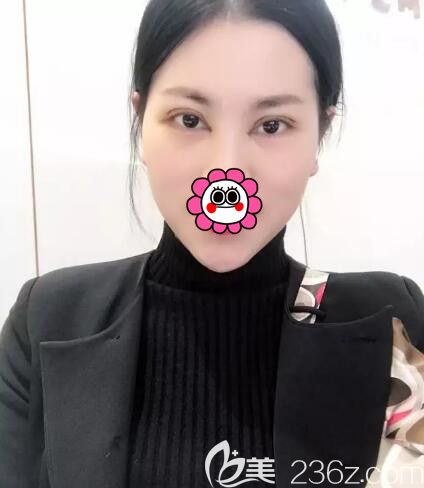 黎曄分享割雙眼皮術(shù)后10天恢復(fù)情況 黎曄分享割雙眼皮術(shù)后10天恢復(fù)情況