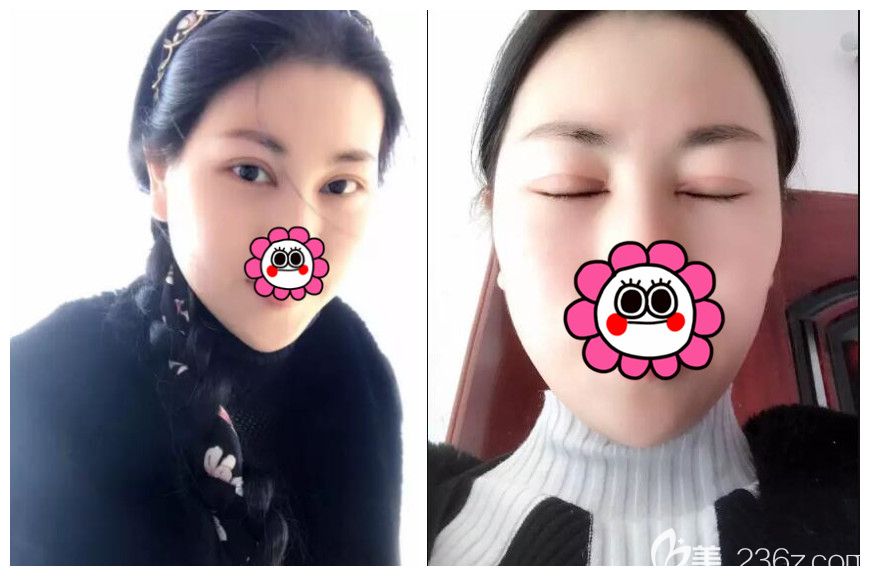 術(shù)后半個(gè)月割雙眼皮恢復(fù)情況閉眼微痕 術(shù)后半個(gè)月割雙眼皮恢復(fù)情況閉眼微痕