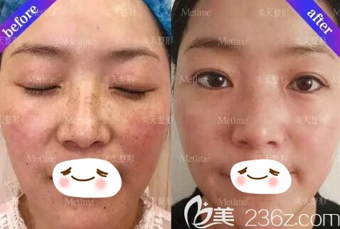雙皮秒祛斑真人前后效果對(duì)比