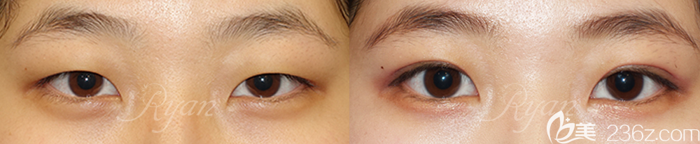 韓國瑞恩雙眼皮案例前后效果對比圖 韓國瑞恩雙眼皮案例前后效果對比圖