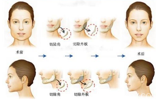 手術(shù)過程示意圖 手術(shù)過程示意圖