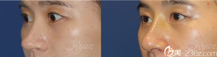 韓國瑞恩隆鼻案例前后效果對比圖 韓國瑞恩隆鼻案例前后效果對比圖