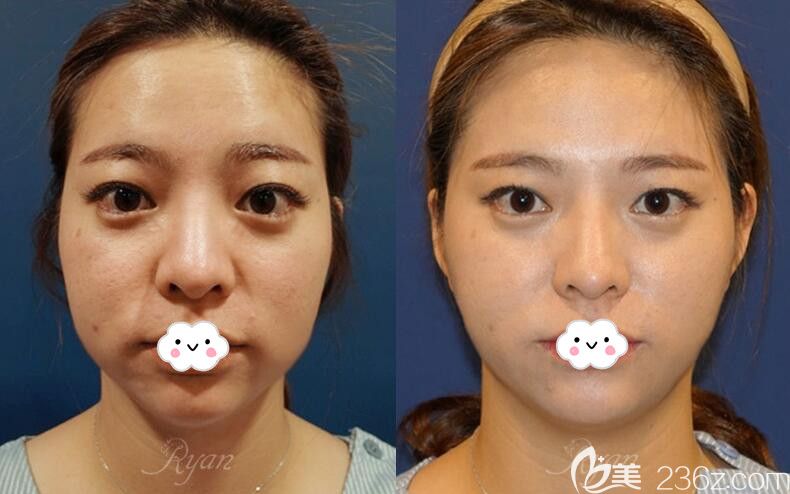 韓國瑞恩超聲超+脂肪溶解針效果前后對比圖 韓國瑞恩超聲超+脂肪溶解針效果前后對比圖