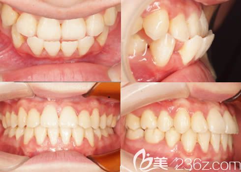 廈門(mén)登特口腔牙齒美學(xué)正畸前后圖