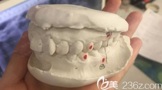 需要拔掉的牙齒圖示 需要拔掉的牙齒圖示