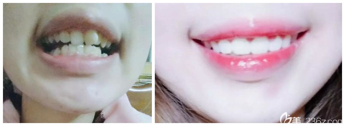 張彼得深覆合矯正案例前后對(duì)比照片 張彼得深覆合矯正案例前后對(duì)比照片