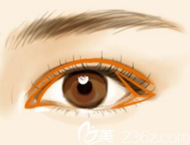 沈陽(yáng)雙眼皮修復(fù)哪里好？