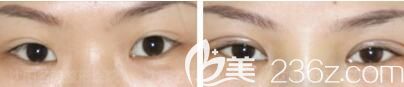 王莉莉雙眼皮修復(fù)真人前后對(duì)比