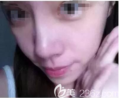 剛注射完玻尿酸鼻子效果