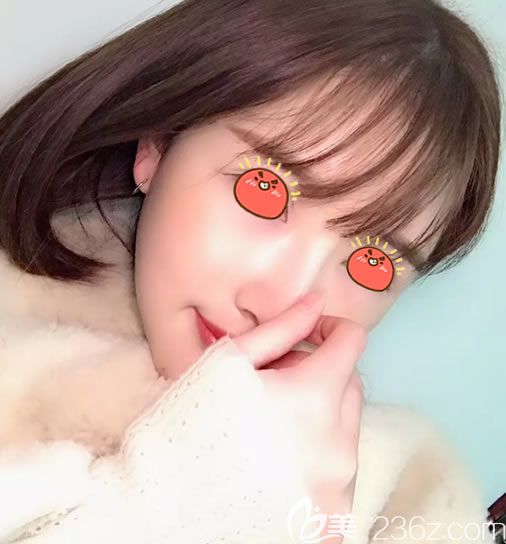 義烏陽光整形醫(yī)院員工透露做自體肋軟骨隆鼻多少錢和保持3個月的效果圖片