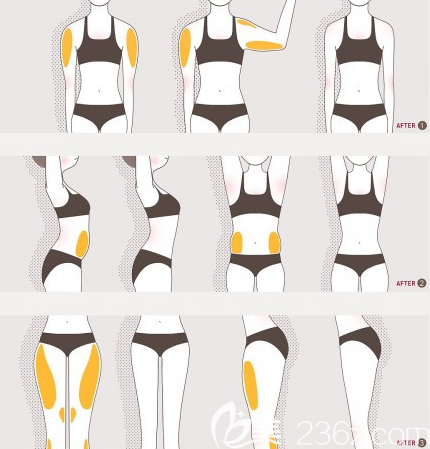 韓國(guó)AP整形外科醫(yī)院吸脂效果原理圖 韓國(guó)AP整形外科醫(yī)院吸脂效果原理圖