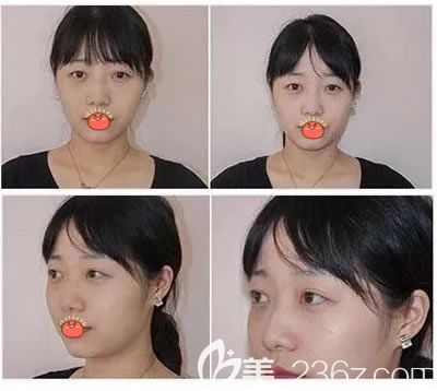 義烏陽光醫(yī)院做雙眼皮手術(shù)前 義烏陽光醫(yī)院做雙眼皮手術(shù)前