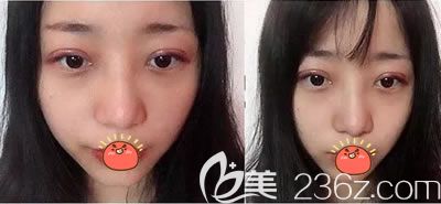 義烏陽光做雙眼皮<span style= 義烏陽光做雙眼皮<span style=