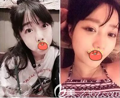 義烏陽光醫(yī)院雙眼皮<span style= 義烏陽光醫(yī)院雙眼皮<span style=