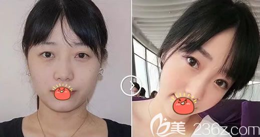 義烏陽光雙眼皮<span style= 義烏陽光雙眼皮<span style=