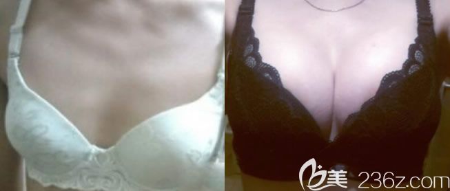 北海美秀中禾隆胸案例效果