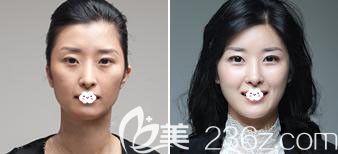 韓國(guó)AP整形外科醫(yī)院<!--<i data=20240703-sp></i>-->面部輪廓案例 韓國(guó)AP整形外科醫(yī)院<!--<i data=20240703-sp></i>-->面部輪廓案例