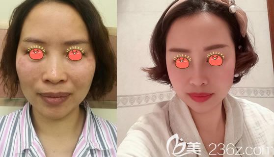 金華瑞麗假體隆鼻案例對(duì)比圖 金華瑞麗假體隆鼻案例對(duì)比圖