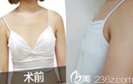 我在北海美秀中禾整形做隆胸前 我在北海美秀中禾整形做隆胸前