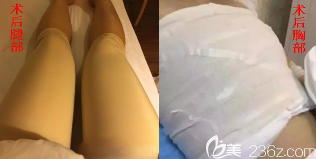 我在北海美秀中禾做吸脂隆胸術后 我在北海美秀中禾做吸脂隆胸術后