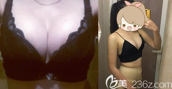 我在美秀中禾做自體脂肪隆胸術后一周照片 我在美秀中禾做自體脂肪隆胸術后一周照片