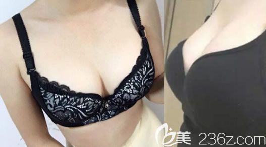 北海整形醫(yī)院哪家好？用我在美秀中禾整形做大腿吸脂和自體脂肪隆胸真實案例來說話