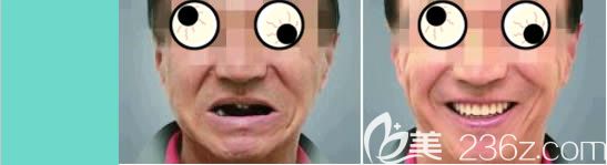 福州維樂口腔陳獻禮院長全口種植牙案例效果圖 福州維樂口腔陳獻禮院長全口種植牙案例效果圖