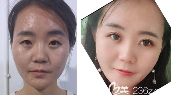 蘭州時光羅梅全切雙眼皮+開眼角第15天效果