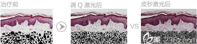 上海伯思立醫(yī)療美容門診部蔡敏皮秒激光原理