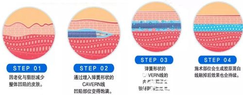 韓國CAVERN提升原理