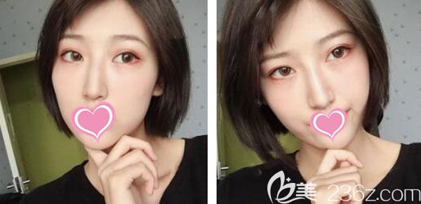 雙眼皮術(shù)后第3天眼睛腫脹比較嚴重 雙眼皮術(shù)后第3天眼睛腫脹比較嚴重