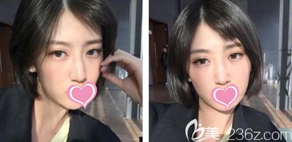 雙眼埋線恢復第7天圖片眼部的腫脹基本已經(jīng)消退 雙眼埋線恢復第7天圖片眼部的腫脹基本已經(jīng)消退