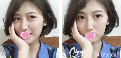 埋線雙眼皮10天恢復圖眼睛又大又有神 埋線雙眼皮10天恢復圖眼睛又大又有神