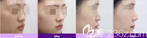 韓國(guó)玉芭隆鼻修復(fù)案例