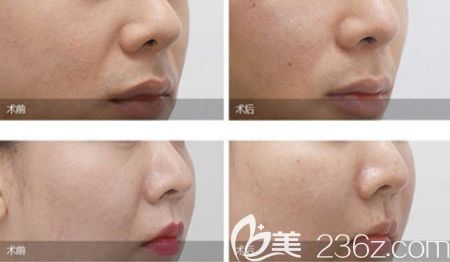 韓國(guó)玉芭埋線提升案例