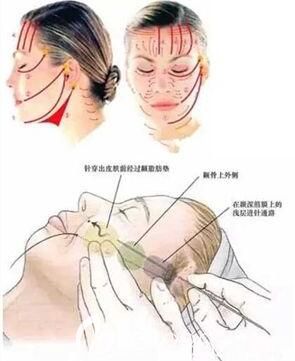 上海伯思立醫(yī)療美容門(mén)診部章春芳 埋線提升 上海伯思立醫(yī)療美容門(mén)診部章春芳 埋線提升