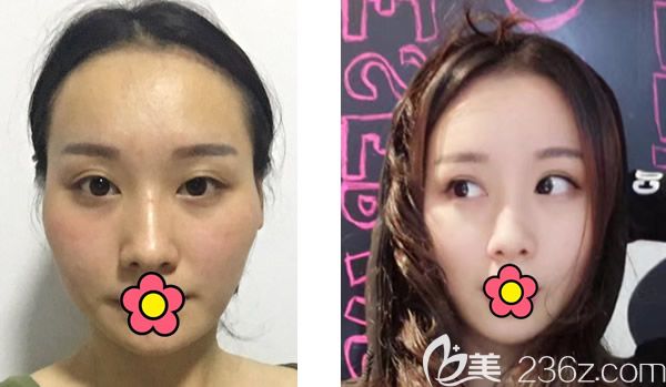 呼市京美朱京成自體脂肪填充全臉前后對比