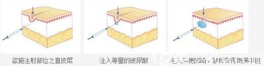 上海伯思立醫(yī)療美容門診部高泉 玻尿酸除皺原理 上海伯思立醫(yī)療美容門診部高泉 玻尿酸除皺原理