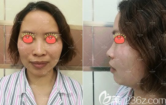 金華瑞麗做假體隆鼻手術(shù)前 金華瑞麗做假體隆鼻手術(shù)前