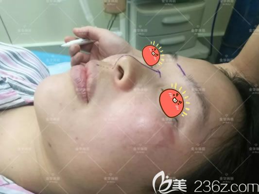 金華瑞麗劉政設(shè)計(jì)隆鼻方案 金華瑞麗劉政設(shè)計(jì)隆鼻方案